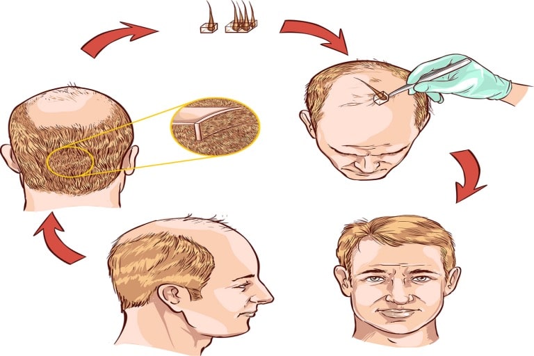 hair transplants